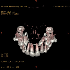 Scanner 3D maxillaire